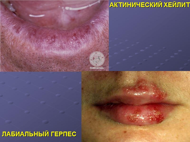 АКТИНИЧЕСКИЙ ХЕЙЛИТ ЛАБИАЛЬНЫЙ ГЕРПЕС